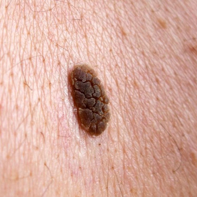 Seborrhoeic Keratoses (1)