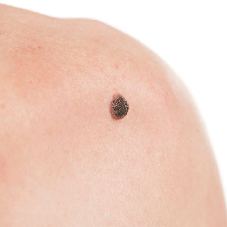 Squamous Cell Carcinoma