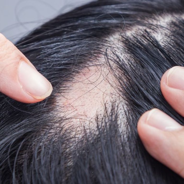 alopecia