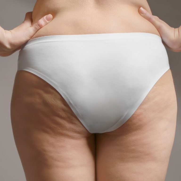cellulite