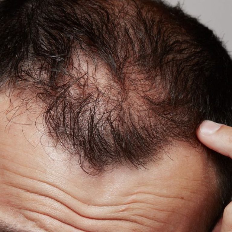male alopecia