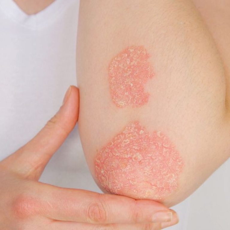 psoriasis (1)