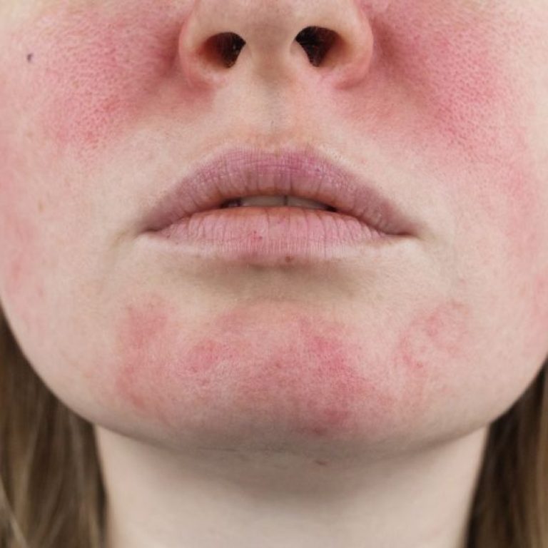 rosacea