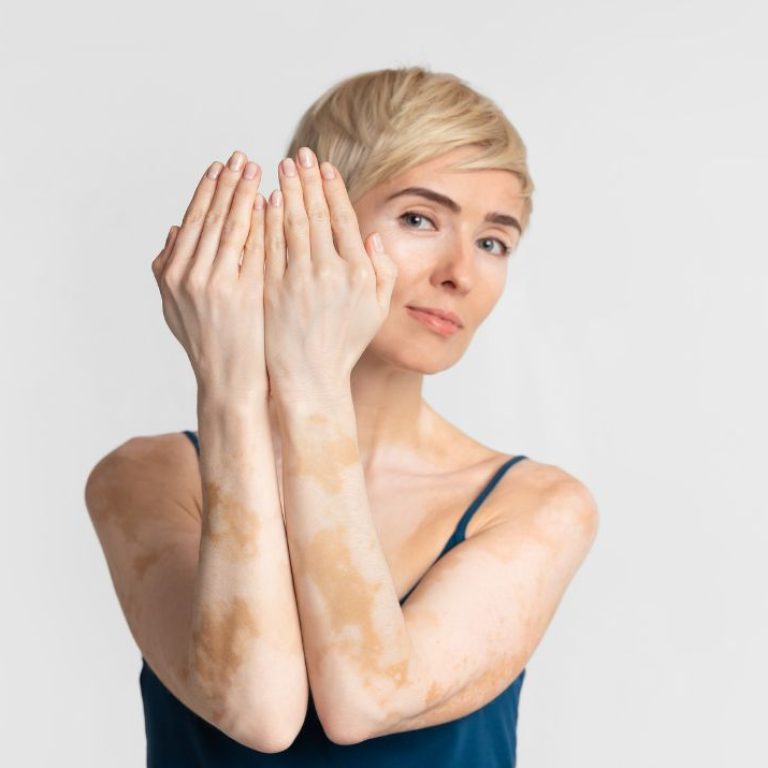 vitiligo